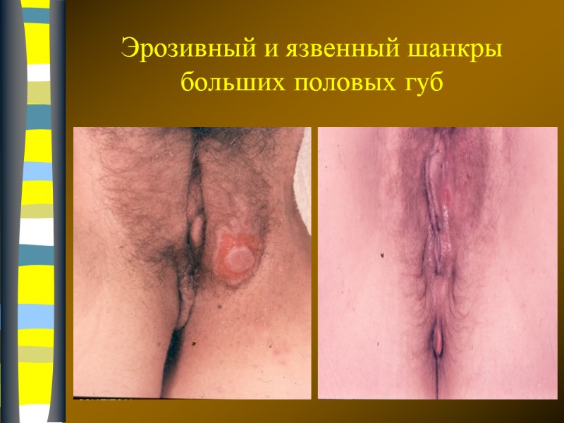 09.12.2017 Эрозивный и язвенный шанкры больших половых губ